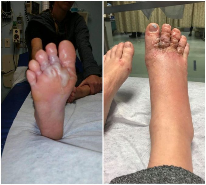 Katie Stephens Went For Walk On Beach, Gasped As She Saw Her Feet