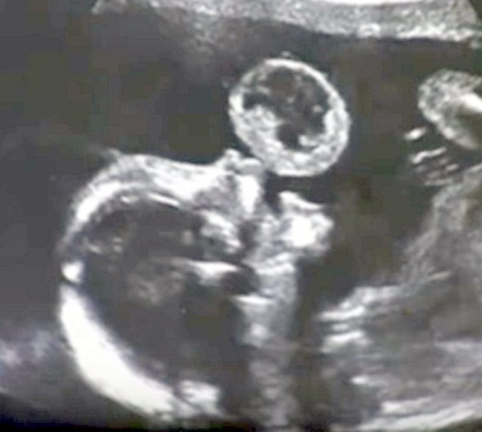 Tammy Gonzalez Sees Puzling Ultrasound, Doctor Says To Abort