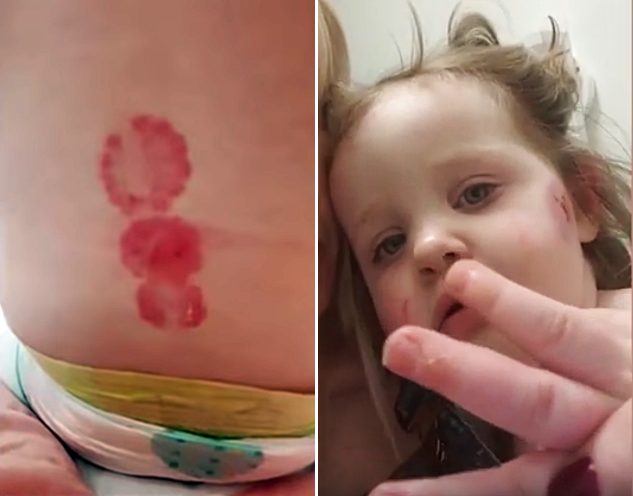 Little Bees Play Center: Toddler Left With Injuries After Bitten 15 Times