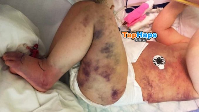 Elisabeth Nordgarden Mom Wrongly Believes Her Son Got Stung By Wasp His Body Turns Blue