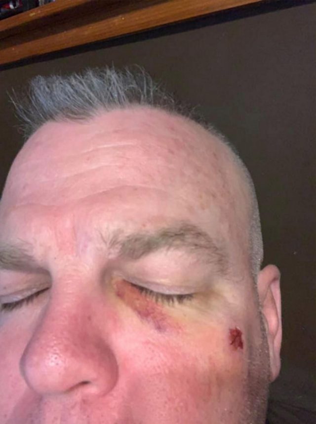 Daniel Sprague Retired NYPD Officer Says Woman Punched Him In Face Left It Bloody On His Birthday Over Red Cap That Looked Like MAGA Hat